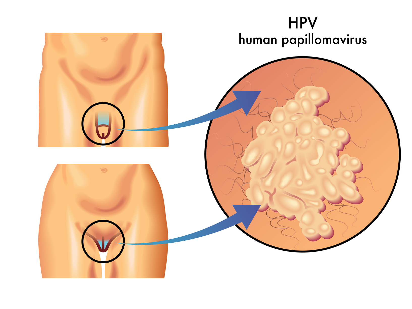 HPV szűrés - Humán Papillómavírus teszt