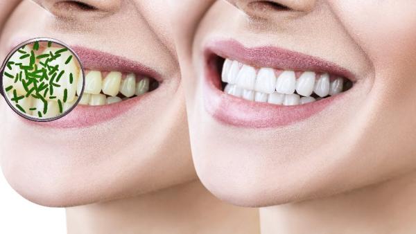 Как протича процедурата при почистване на зъбите?