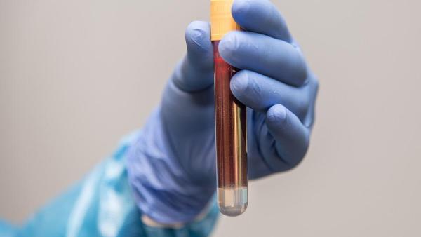 Тест за пикочна киселина в кръвта при подагра - какво трябва да знаем