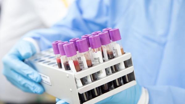 Цялостен метаболитен панел (CMP) - какво трябва да знаем за кръвното изследване