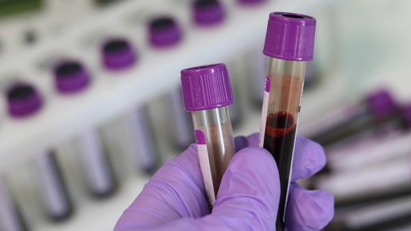 Изследване на глобулини в кръвта - какво трябва да знаем