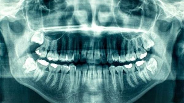 рентгенова снимка на зъб