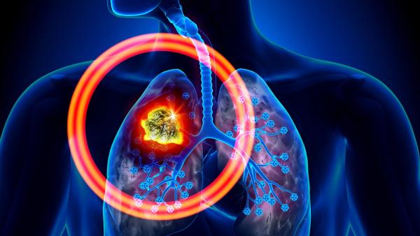 Рак на белите дробове. Симптоми и диагностика