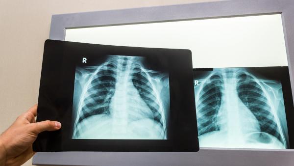 Какво трябва да знаете за рентгенографията на гръден кош?