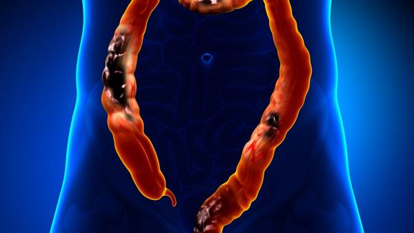 Рак на дебелото черво. Симптоми и диагностика