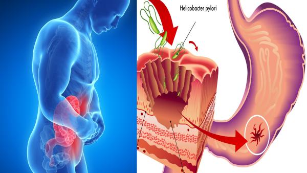 Знаете ли, че 70 % от населението са носители на Helicobacter pylori? Ето и симптомите!