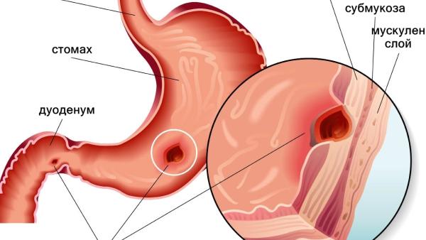 Как да разпознаем симптомите на язвената болест? Вижте причините и рисковите фактори!