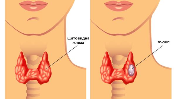 Възлеста гуша (нодозна струма) – какво знаете за щитовидните възли и кога трябва да се лекуват?