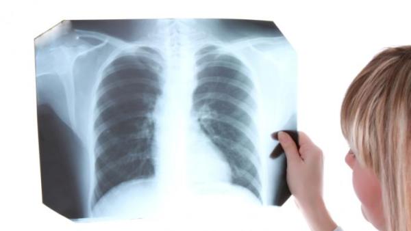 Нов тест открива наличието на туберкулоза в организма