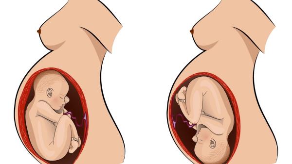 Какви са възможните предлежания на бебето в матката и какво е тяхното значение?
