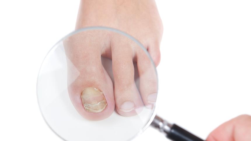 Гъбички по ноктите – Разпознаване, Предпазване и Лечение