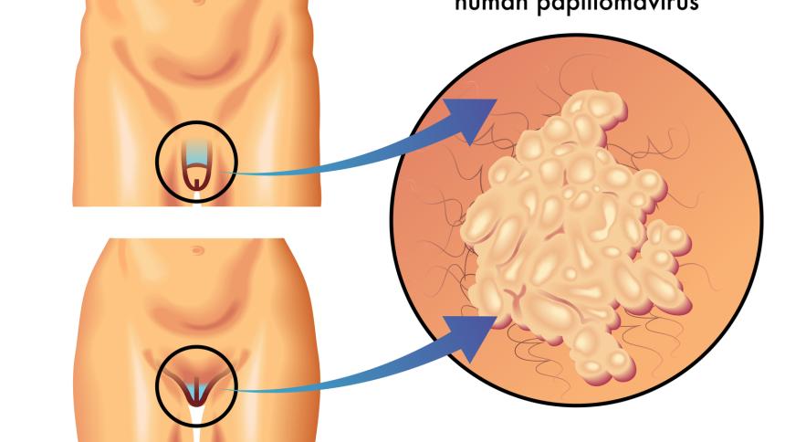 Ниско- и високорискови човешки папиломни вируси (HPV)! Кои са най-разпространени?