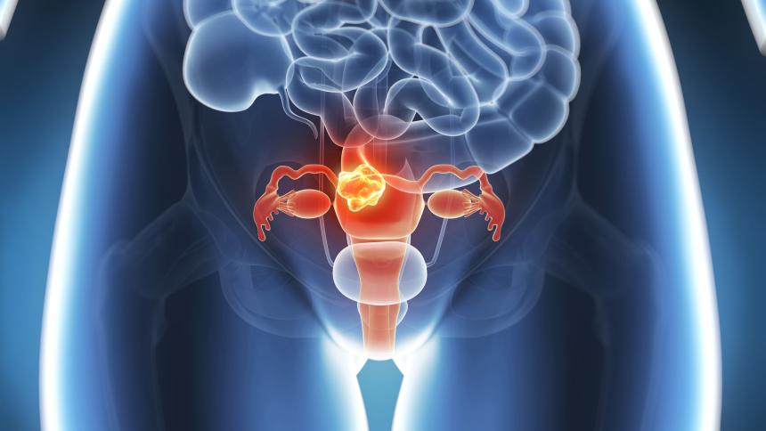 Рак на матката (ендометриален карцином) – какво трябва да знае всяка жена за него?