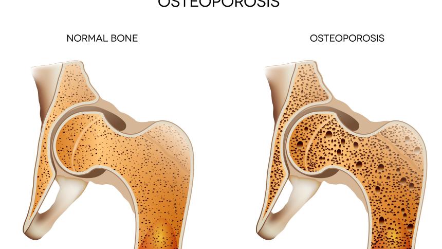 Остеопорозата тихата болест. Какво трябва да знаете?