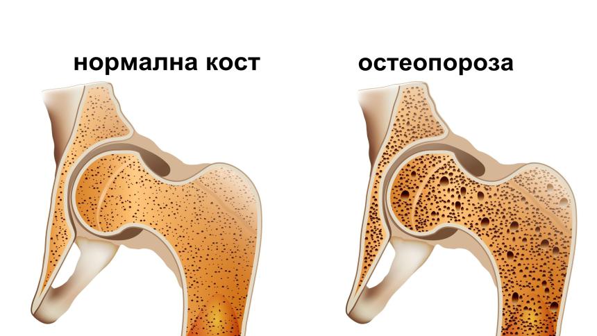 Остеопороза – какво трябва да знаем за нея? Защо менопаузата е причина за това заболяване?