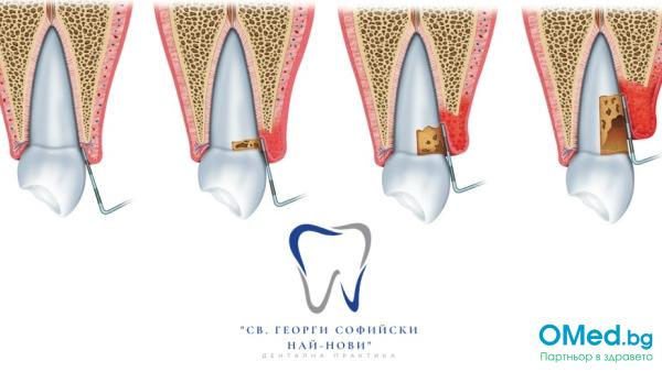 Лечение на пародонтоза с доказано най-ефективния лазер-Biolase Waterlase за 13 лв. от Дентална практика "Св. Георги Софийски най-нови"