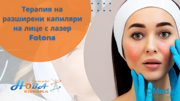 Терапия  на разширени капиляри на лице с лазер Fotona от Клиника Нова Варна!