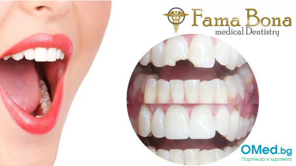 Естетично възстановяване на зъб с композитна фасета - Бондинг от Дентална клиника Fama Bona за 50.30 лв.