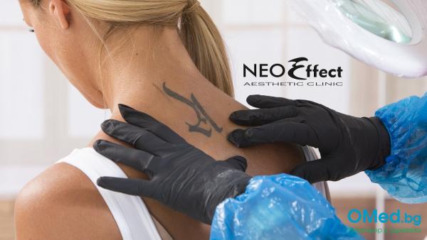 Премахване на татуировка с Nd:Yag лазер в Естетична клиника NeoEffect
