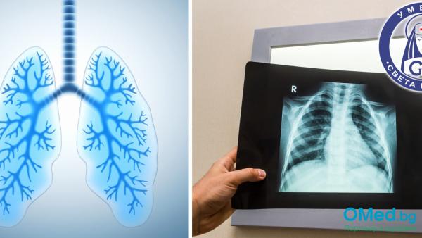 Рентгенография на бял дроб - 2 проекции от УМБАЛ Света Марина гр. Плевен!
