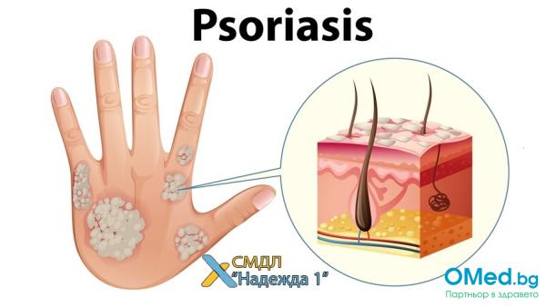 Псориазис? ПКК, ДКК, СУЕ, CRP, RF за 15.40 лв. от СМДЛ "Надежда 1"
