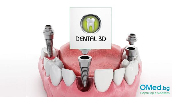 ЗЪБЕН ИМПЛАНТ! Последно поколение титаниеви импланти от 3D Dental Clinic