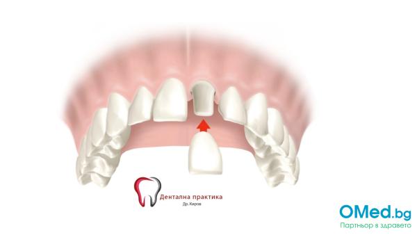 Металокерамична корона от Дентална практика д-р Киров