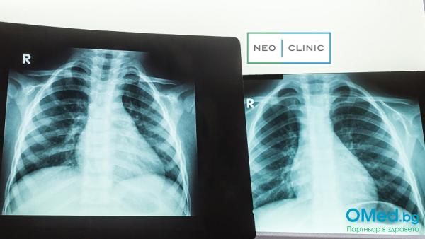 Рентгенова снимка на бял дроб или синуси + разчитане от NEO CLINIC