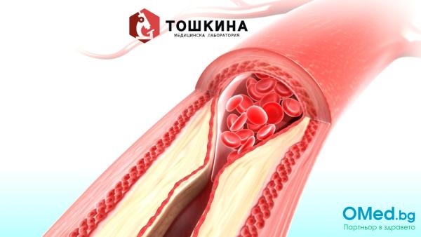 Изследване на различните холестероли - профилактика за здрава сърдечно-съдова система от МЛ "Д-р Тошкина, за 8 лв.