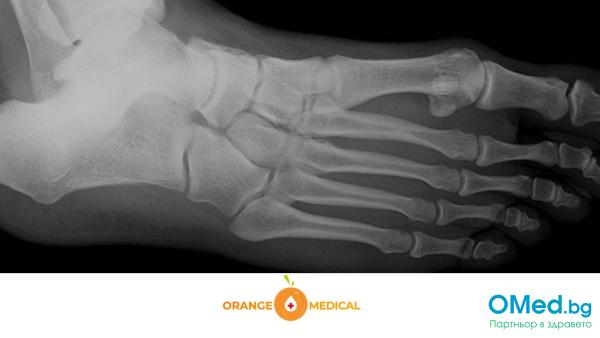 Рентгенова снимка на стъпало и пръсти за 25 лв. от МЦ Ориндж